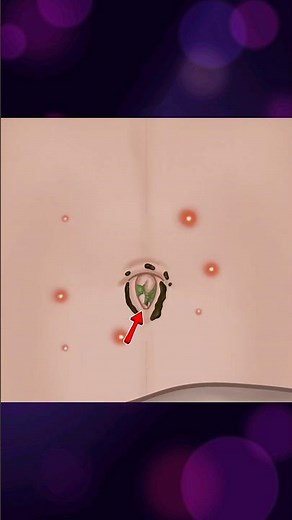 ASMR | Dirt & Stone Removal in Belly Button 😌 Pimple Popping | Animated No BGM#animation