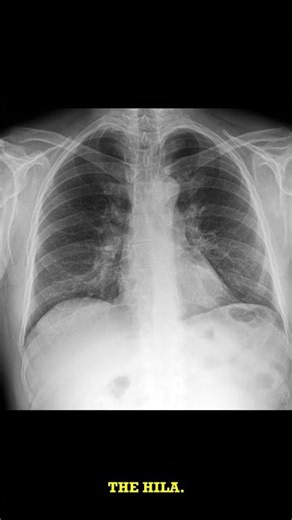 Chronic Bronchitis on Chest X-ray Shows Deformed Markings