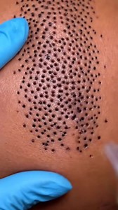 21K views · 91 reactions | Ultimate Blackhead Suction—You Won’t Believe the Before & After! (1) | Celia Kramer | Facebook