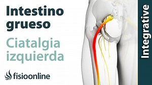 Ciática o ciatalgia izquierda y su relación con el intestino grueso y colón irritable