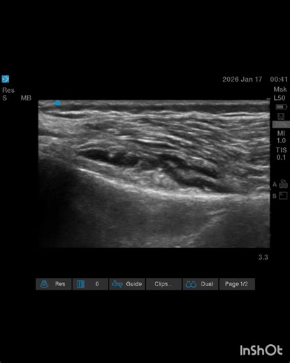 SMGN-rare sight Genicular nerve block Out of plain #painmanagement #MedicalEducation #kneepain | Wiquar Ahmed