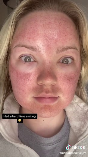 Skin Transformation Journey with Halo and BBL: Before and After Photos