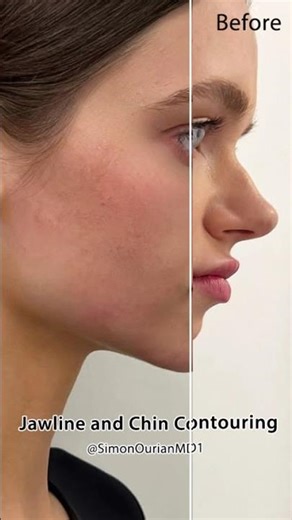 Jawline and Chin Contouring