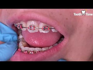 Braces deep bite - Getting Bite Turbos on front teeth - Tooth Time Family Dentistry New Braunfels