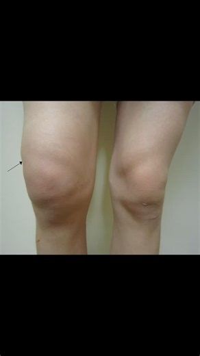 Sports Medicine Review on Instagram: "Balloon sign/test is used to evaluate for a joint effusion of the knee! Click/follow to learn more! Watch: https://www.youtube.com/watch?v=1Mt8oyPpqQs Read: https://wikism.org/Balloon_Sign #SportsMedicine #Orthopedics #PhysicalTherapy #AthleticTraining #Rehab #InjuryPrevention #Physio #SportsInjury #MovementMatters #SportsRehab #PhysioTherapy #Meded #FOAMed"