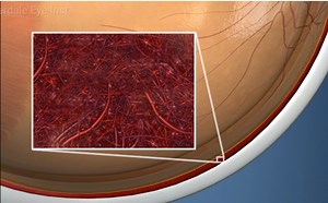 Choroidal Neovascularization | Fort Lauderdale Eye Institute