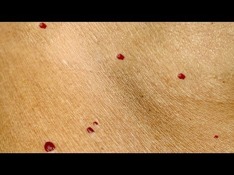 Are these red spots on the skin dangerous? Here's what you should know!