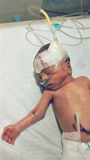 110 reactions · 23 comments | Severe Sepsis in Extreme Low Birth Weight Baby #baby # #ternding #reel | Parmod Gatuam | Facebook