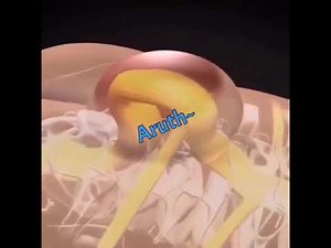 Video-Animação - Espinha Bífida - Spina Bifida (video-animation)