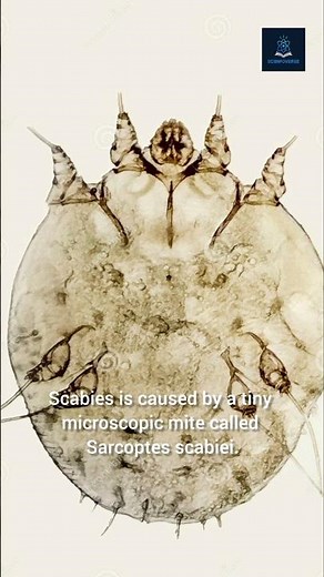 🔬 Scabies: The Tiny Mite That Causes Intense Itching