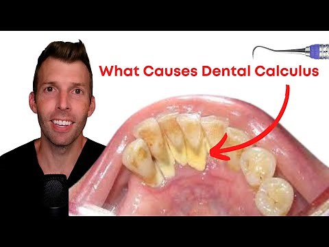 What DENTAL CALCULUS Really Means (on the Carnivore Diet)