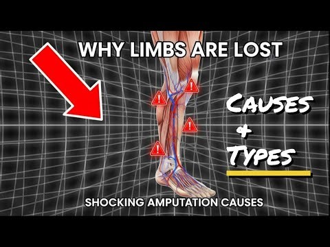 Amputation Causes and Types