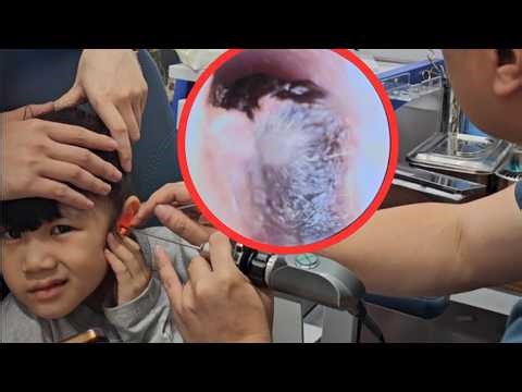 Ep. 12 Remove Earwax For A Little Girl - Deep Ear Cleaning 耳かき - ASMR 耳掃除