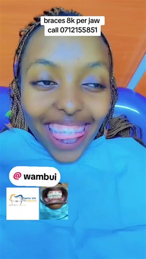 braces to align teeth #familylifedentalclinic