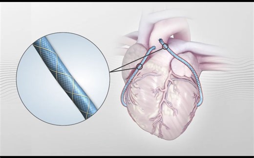 Vascular Graft Solutions的VEST™系统