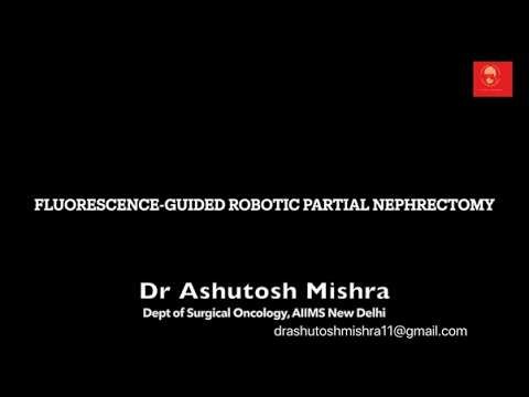 Fluorescence-Guided Robotic Partial Nephrectomy using Indocyanine Green (ICG)