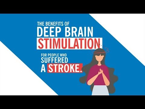 Deep Brain Stimulation is Promising for Stroke Patients, Study Shows