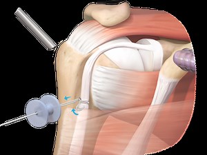 Knotless TensionTight™ Tenodesis Technique