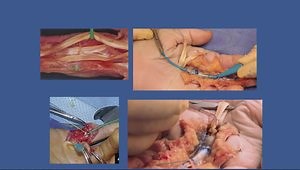 Flexor Tendon Injuries