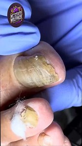 Light steady steps that ease thick-nail care 🍡🍎 #carefocus #softsteps #wellnessmoves | NC State Wolfpack on TheWolfpacker.com