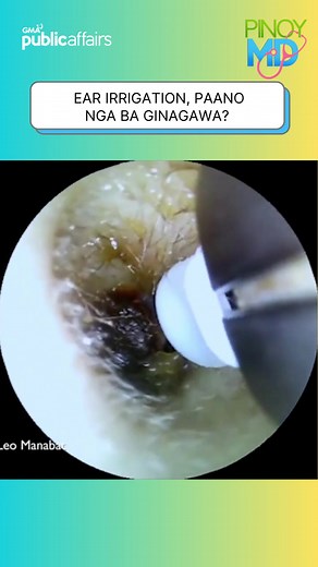 Ear Irrigation: Paano Ginagawa para sa Malinis na Tenga