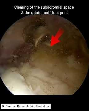 Arthroscopic rotator cuff repair#rotatorcuffrepair
