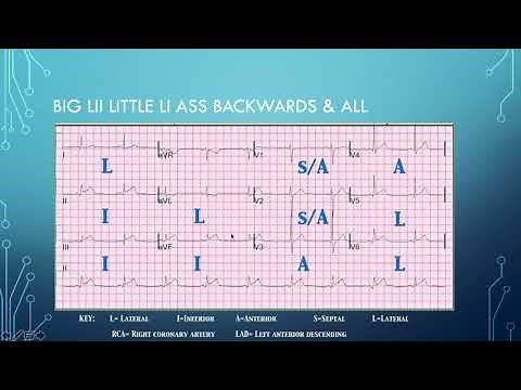 Quick 12-lead EKG Review: Location of Infarct and Which Artery is Affected