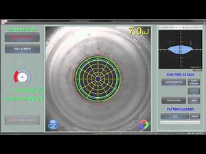High resolution Scheimpflug imaging of a cataract using the Lensar System
