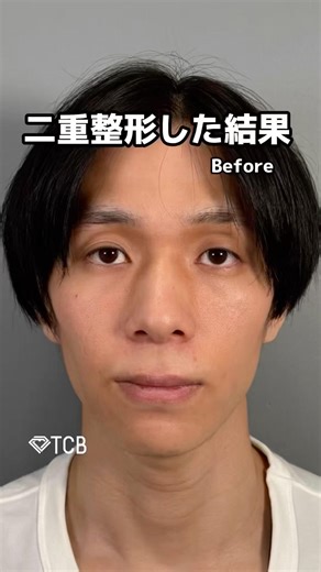 【二重整形】二重整形した結果#shorts
