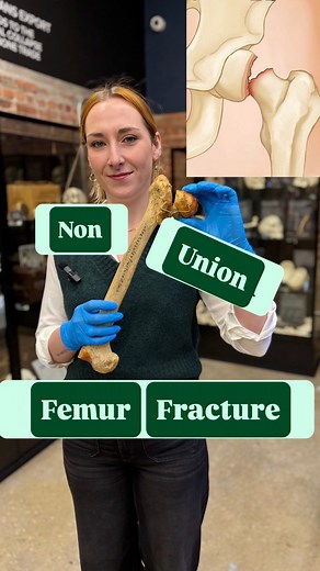 When bones break… they’re supposed to heal. But what happens when they don’t? 👀 This femur never fused back together—what you’re looking at is a non-union fracture. In this video, we’ll show you how it looks on real bone, why some fractures refuse to heal, and what that means for the person living with it. | The Bone Museum