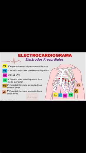 Understanding EKG Leads: V1, V2, V3, V4, V5, V6 Explained