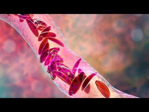 MDHHS unveils new plan to break down barriers for sickle cell disease patients in Michigan