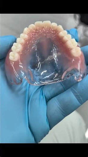 Adsorption denture fabrication #3ddenture #dentist #smiledesigndental