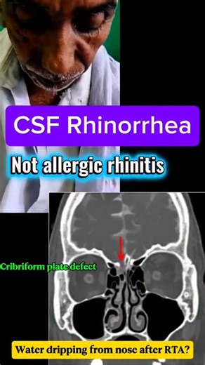 Adeel Ur Rehman on Instagram: "Water Dripping From Nose After RTA? 🚨 Think CSF Rhinorrhea This patient presented after a road traffic accident with continuous clear fluid dripping from the nose — often mistaken for simple rhinitis. But imaging tells the real story. 📌 CT PNS – Bone Window (Coronal) shows a cribriform plate defect, confirming CSF rhinorrhea due to skull base fracture. ⚠️ Missing this diagnosis can be fatal → high risk of meningitis. 👉 Clear nasal discharge after trauma is CSF u