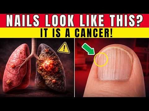 Seniors: If Your Fingernails Look Like This, It's a Hidden Sign of Cancer (Doctor Explains)!