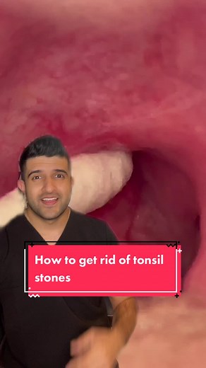Effective Ways to Remove Tonsil Stones and Improve Oral Health