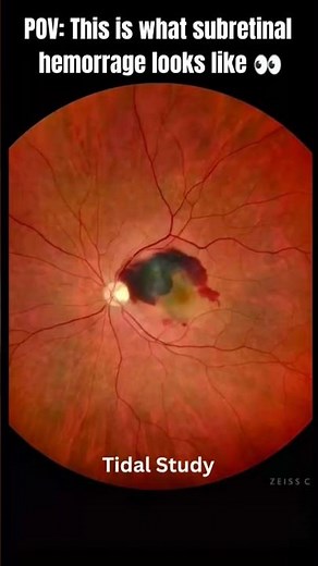 Subretinal hemorrhage | vision threatening eye emergency!