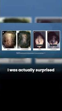 Unexpected Ketoconazole Hair Regrowth (Study Results)