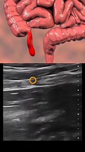 4.6K views · 22 reactions | Appendicitis | Ultrasound signs. Part 2 | Med G | Facebook