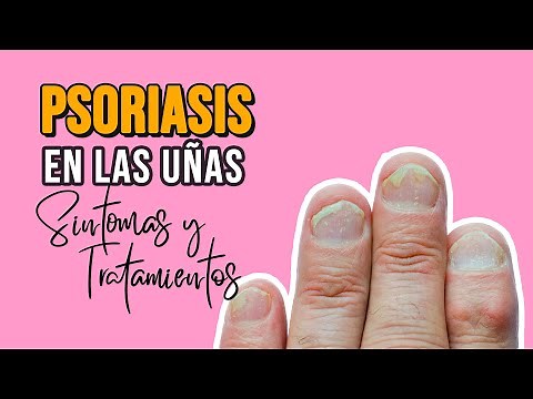 Psoriasis En Las Uñas, Causas Y Como Tratarla Efectivamente
