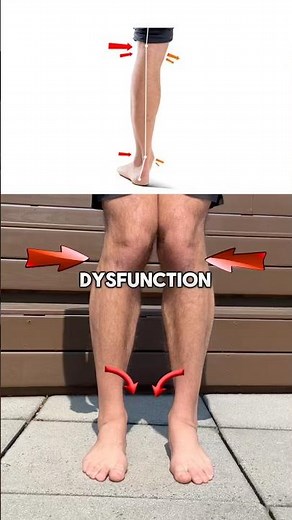 How to Fix “Flat Feet”
