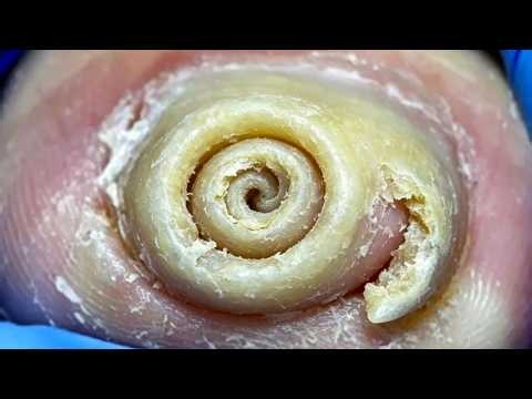 Toenails Have Two Sharp Corners Remove Large Ingrown Toenails【Pedicure Master Lin Jun】