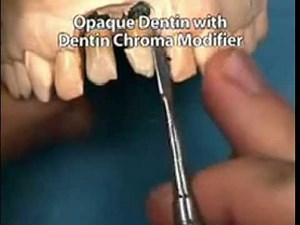 Integrated Abutment Crown™ Laboratory Technique