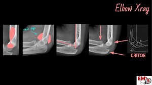 Elbow Xray Interpretation