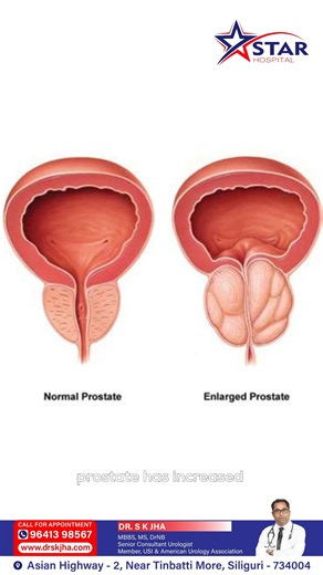 Don’t panic if your ultrasound shows an enlarged prostate. 🩺 Prostate enlargement is a common condition and, in most cases, it is not cancer. In this video, Dr. S. K. Jha, Senior Consultant Urologist, explains what an enlarged prostate really means, the importance of proper evaluation, and the right next steps to protect your health. With timely consultation and the right tests, concerns can be addressed effectively. 📞 For appointments: 96413 98567 🌐 Visit: www.drskjha.co.in 📍 Address: Star 