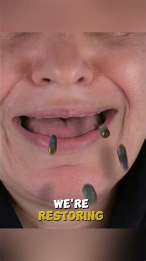 The "Big Reveal" Full Mouth Smile Makeover with Implants #shorts #dentist #dentistry #smilemakeover