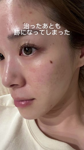 ポテンツァによるニキビ跡治療の効果と体験