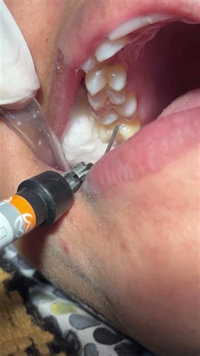 composite filling #dental #dentist