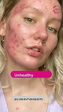 Acne Treatment Not Working? You Need to Know This! 🔥