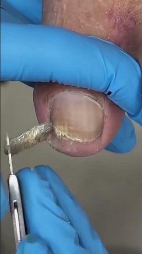 Proses pemotongan kuku kaki yang menarik… #pedikur